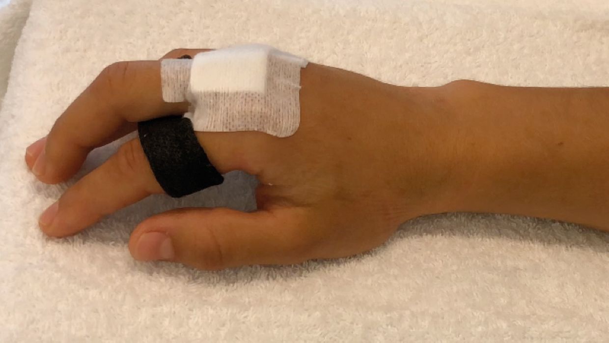 Behandlung von Strecksehnenverletzungen an der Hand Orthopädie & Traumatologie Universimed